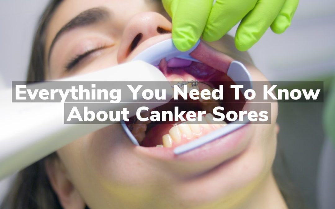 Everything You Need to Know About Canker Sores